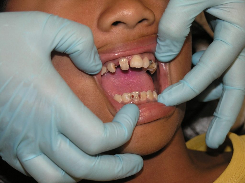 percer un abcès dentaire naturellement